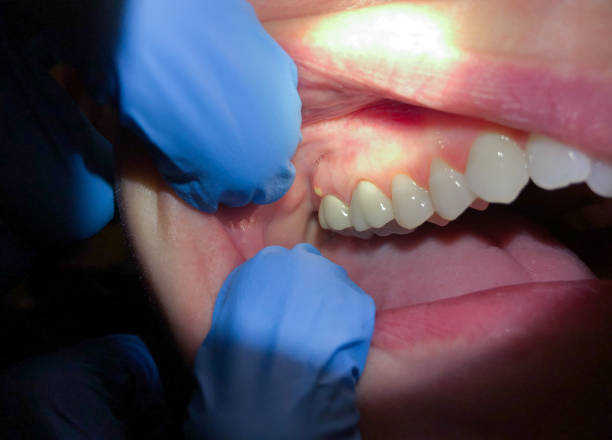 Tooth Infection Emergency Dentist in SC